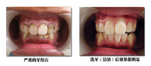 合肥治疗牙结石的医院哪家好,合肥治疗牙结石怎么办