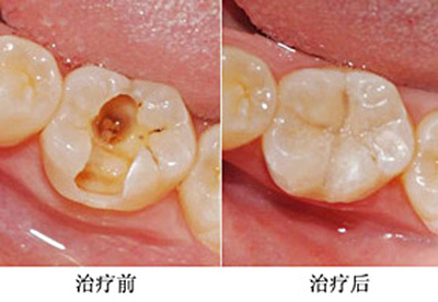 合肥补牙的价格