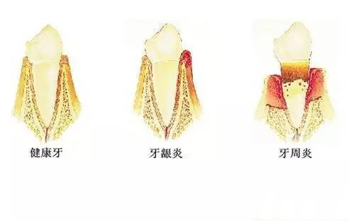 牙周炎