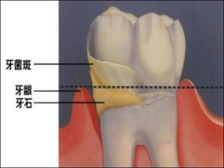 合肥牙结石怎么办,