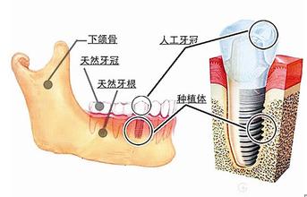 成人种植牙多少钱一颗？