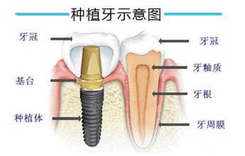 成人种植牙多少钱一颗？