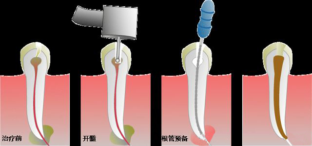 根管治疗需要注意哪些