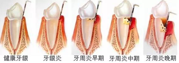 牙龈出血