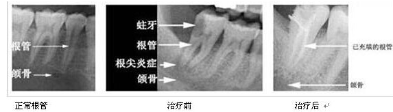 根管治疗