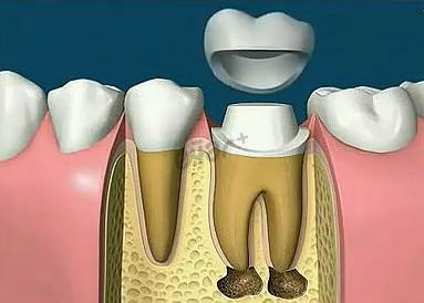 根管治疗要注意哪些