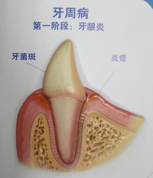 牙周炎是怎么形成的