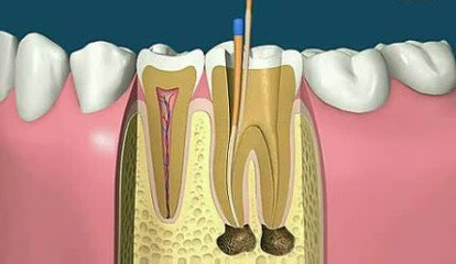 根管治疗有哪些优势