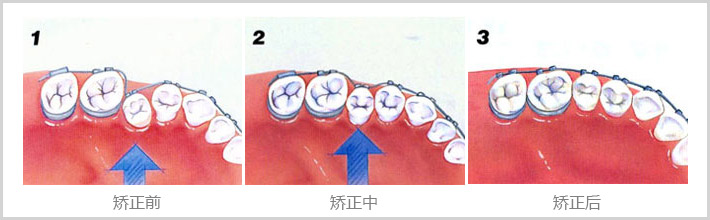 牙齿矫正