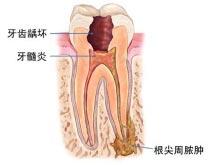 牙龈炎