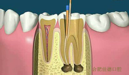 根管治疗怎么治疗