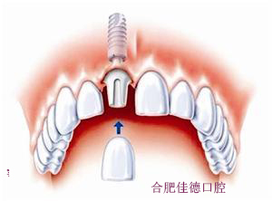 馕牙需要多少钱