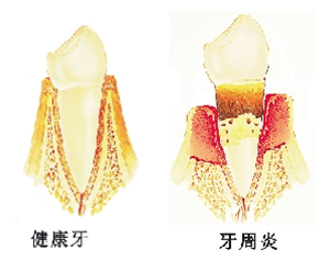 牙周炎