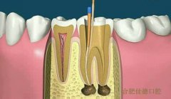 合肥蛀牙做根管治疗多少钱