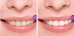 牙齿美容成功有哪些关键因素