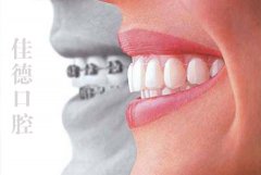 成年人适合做牙齿矫正吗？